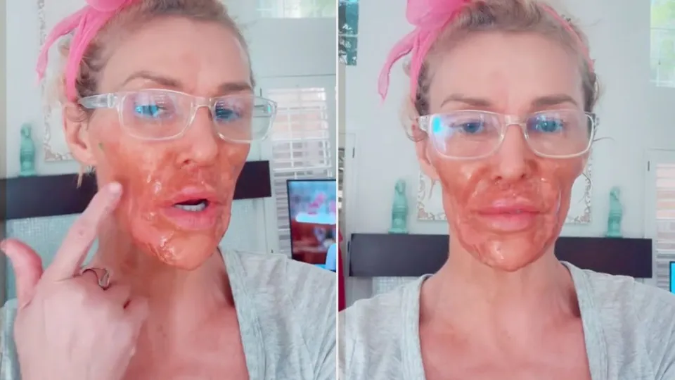 Ex-modelo Brandi Glanville mostra novo rosto após iniciar tratamento